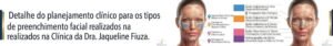 Infográfico detalhado do planejamento clínico para diversos tipos de preenchimento facial valinhos, exibindo áreas de tratamento no rosto e descrições dos produtos como Ácido Hialurônico e Hidroxiapatita de Cálcio.